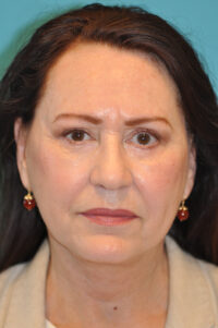 Rhytidectomy (Facelift) Before and After Photos