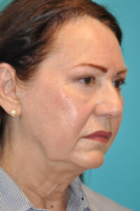 Rhytidectomy (Facelift) Before and After Photos