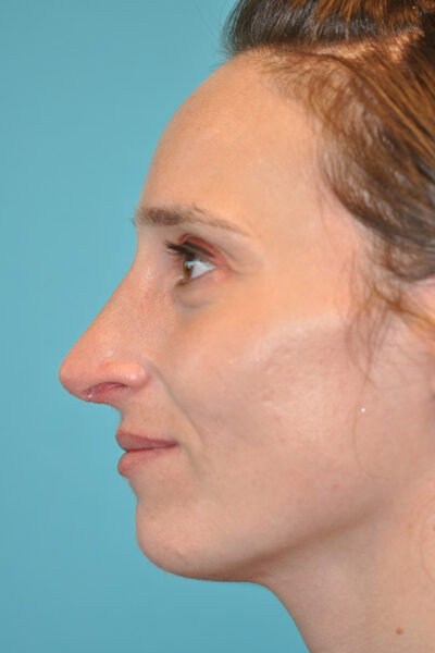 Rhinoplasty (Nose Job) Before and After Photos