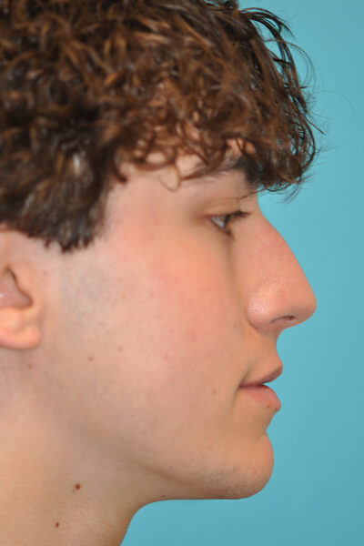 Rhinoplasty (Nose Job) Before and After Photos