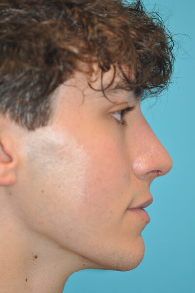 Rhinoplasty (Nose Job) Before and After Photos