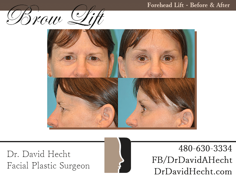 Browlift Results Scottsdale Browlift Results Scottsdale