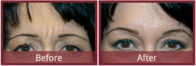 Botox before and after Scottsdale