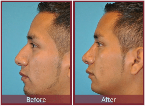 Rhinoplasty Results Scottsdale